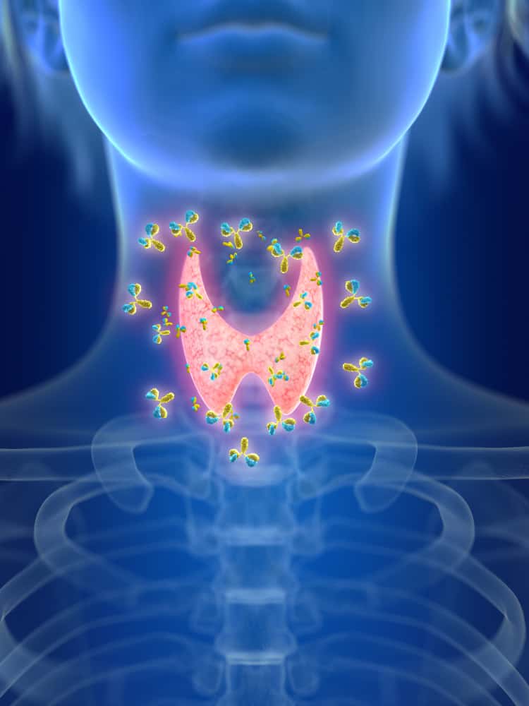 Hashimoto's Hypothyroidism